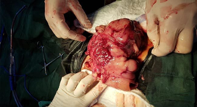 نجاح عملية جراحية نادرة لطفلة في كركوك  