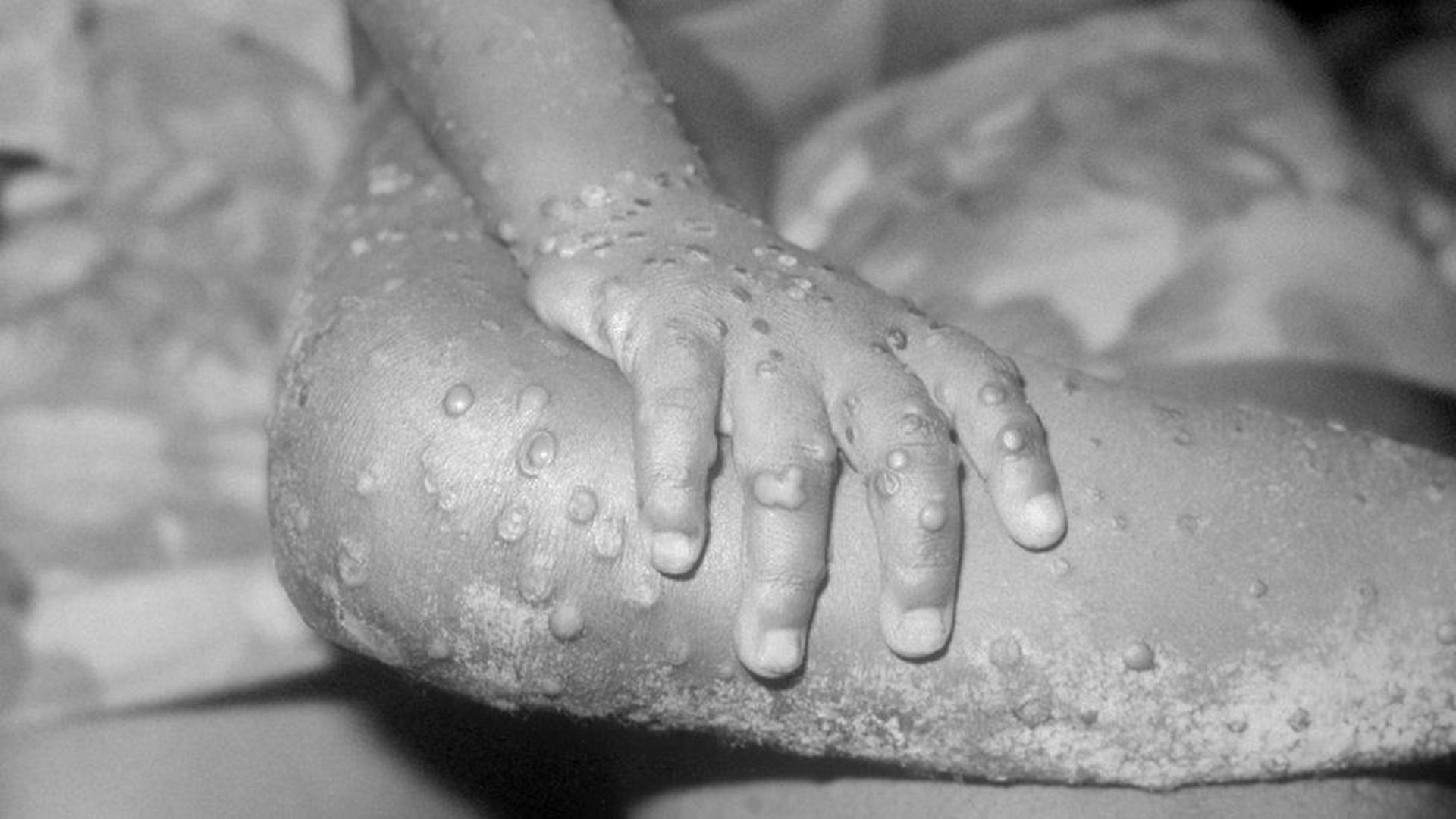Symptoms of monkeypox include a rash, fever, headache, muscle aches, backache, swollen lymph nodes, chills and exhaustion. Photo Credit:  GETTY IMAGES