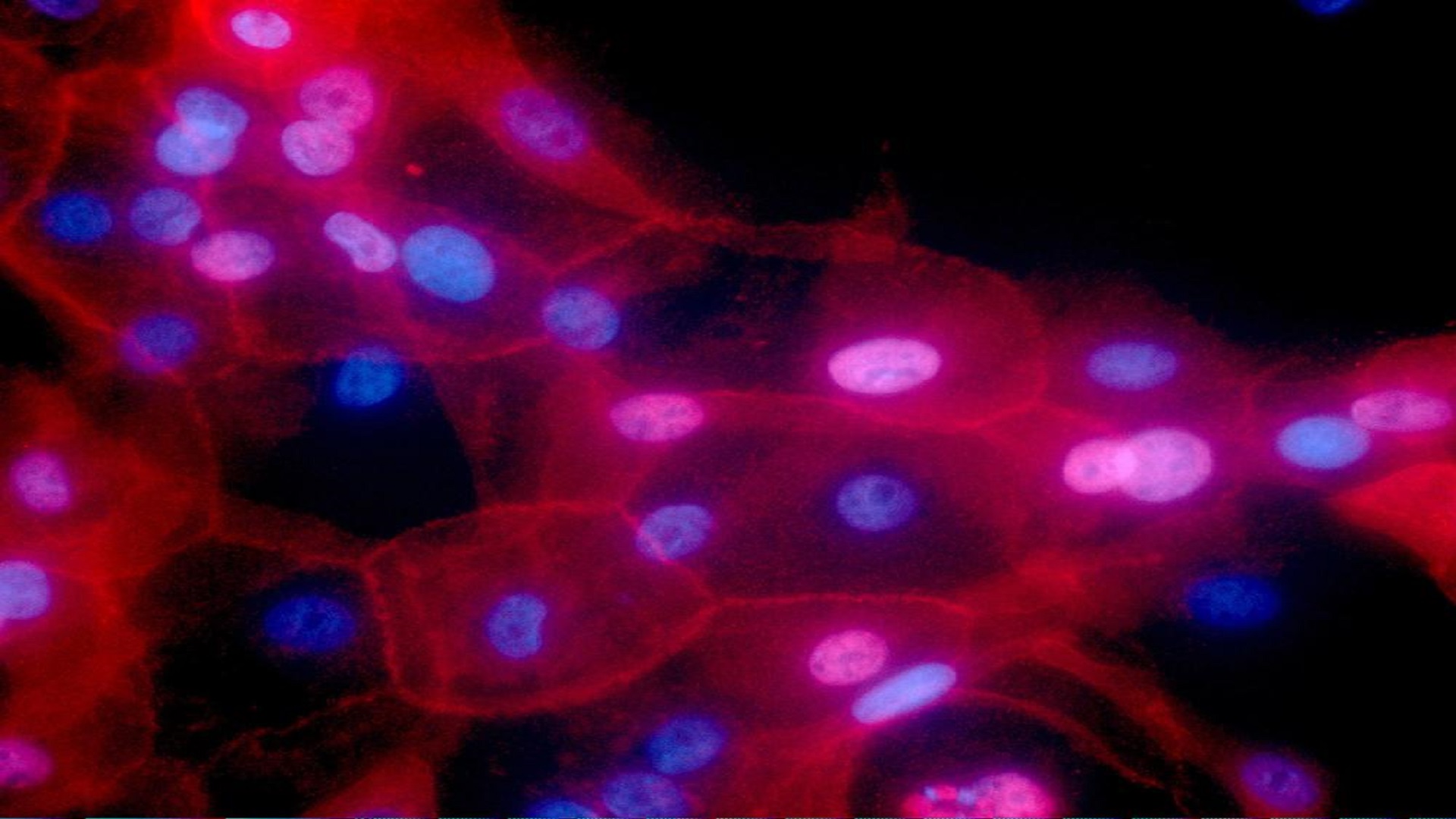 This undated fluorescence-colored microscope image made available by the National Institutes of Health in September 2016 shows a culture of human breast cancer cells.(Ewa Krawczyk/National Cancer Institute via AP)