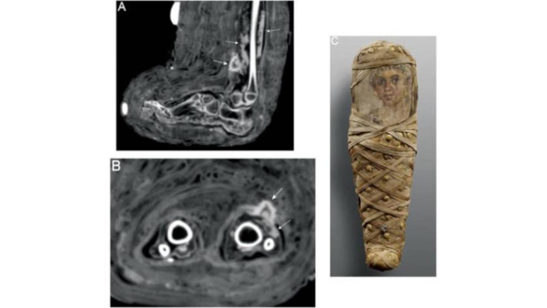  An international research team from Germany, Italy and the US have announced the first-ever discovery of an ancient Egyptian dressing. (International Journal of Paleopathology)